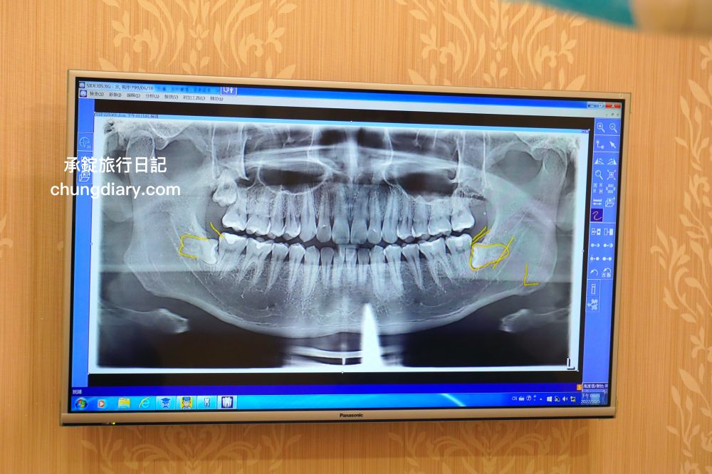 竹北牙醫診所【真美舒眠植牙中心】新竹專業醫師洗牙推薦！牙齒美白、單顆齒雕、微笑曲線設計、牙齦美容諮詢。