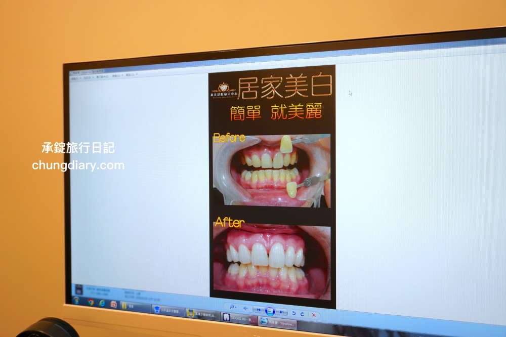 竹北牙醫診所【真美舒眠植牙中心】新竹專業醫師洗牙推薦！牙齒美白、單顆齒雕、微笑曲線設計、牙齦美容諮詢。