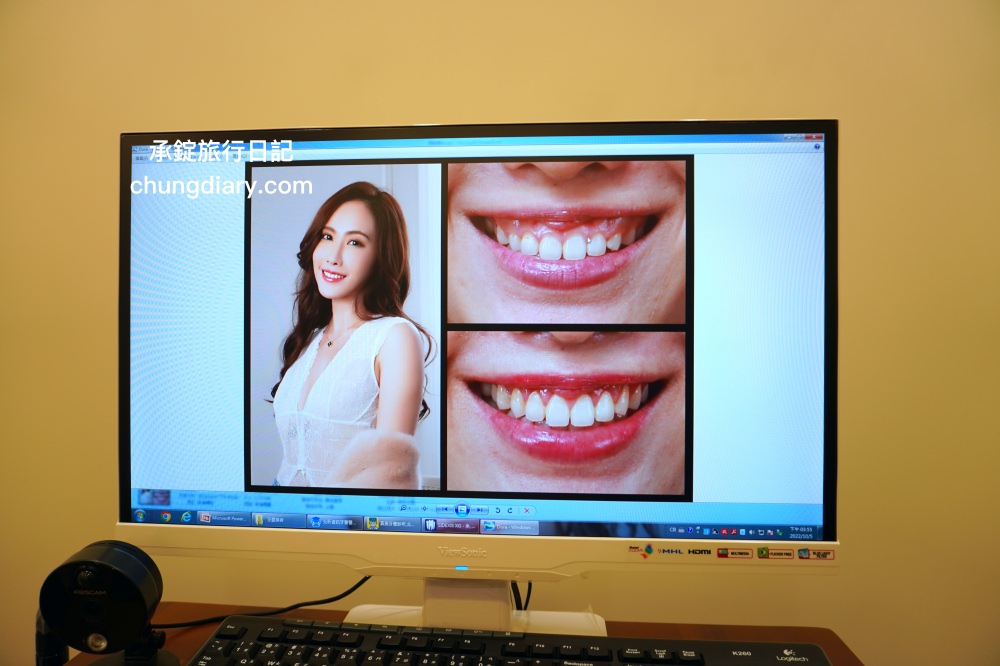 竹北牙醫診所【真美舒眠植牙中心】新竹專業醫師洗牙推薦！牙齒美白、單顆齒雕、微笑曲線設計、牙齦美容諮詢。